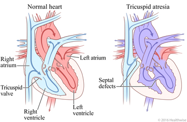 Normal heart and heart without a tricuspid valve, showing smaller right ventricle and change in blood flow