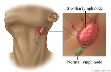 Location of lymph nodes in the neck with close up of swollen lymph node and normal lymph node