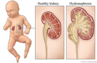 An infant, with a close up of a healthy kidney and a kidney with hydronephrosis