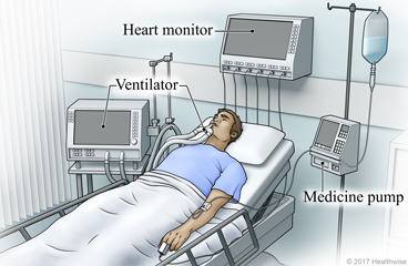 ICU equipment including ventilator, heart monitor, and medicine pump with IV, attached to patient