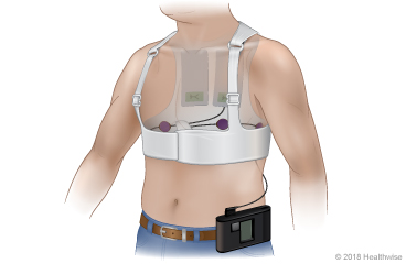 A person wearing a wearable cardioverter-defibrillator