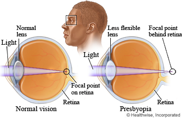 Eyes showing normal vision and presbyopia