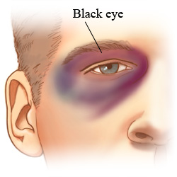 Picture of a black eye