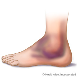 Picture of a bruised ankle