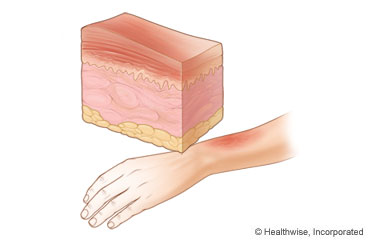 Cross section view of skin with a chemical burn