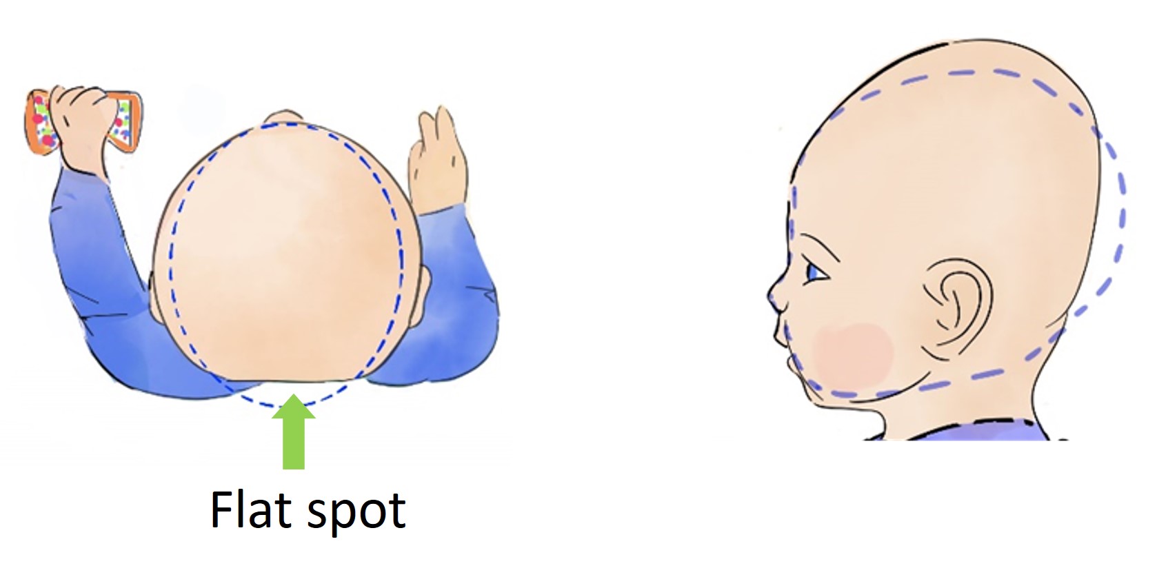 baby with flat spot on back of head