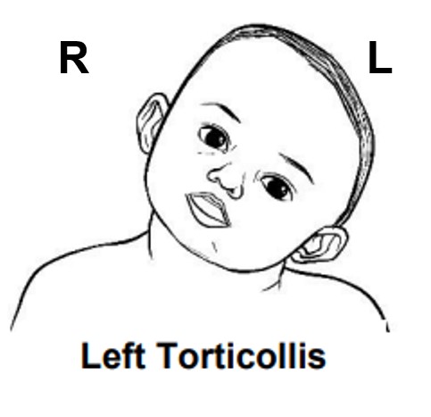 baby with left torticollis