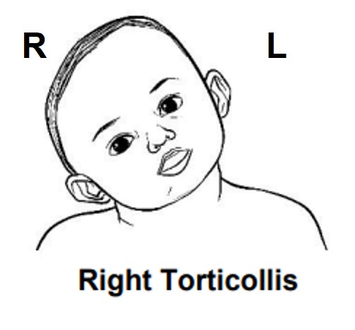 baby with right torticollis