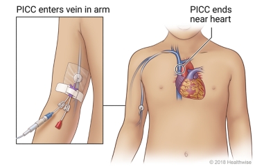 PICC entering vein in arm, showing where it ends near heart