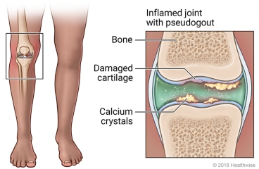 Inflamed knee joint with detail of calcium crystals and damaged cartilage in joint space