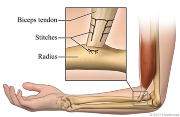 Inside view of the arm, with detail of the biceps tendon and the stitches used to attach it to the radius bone