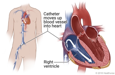 Catheter moves through blood vessel from groin to heart's right ventricle, with detail of right ventricle.
