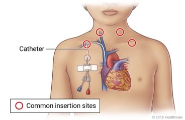 Common insertion sites for a tunnelled catheter