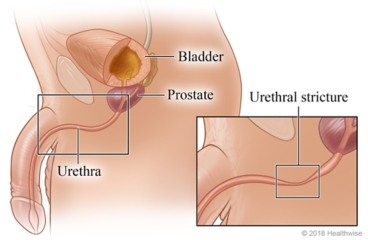 Location of bladder, prostate, and urethra, with detail of urethral stricture