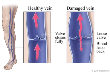 Leg veins, with detail of healthy vein and valve and of damaged vein that allows blood to leak backward