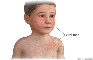 A viral rash on the face and chest of a child.