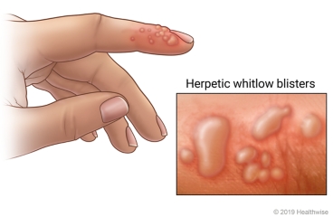 Herpetic whitlow on top section of finger, with close-up of redness and blisters on skin