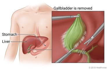 Position of gallbladder under the liver, with detail of surgical tools being used to remove gallbladder