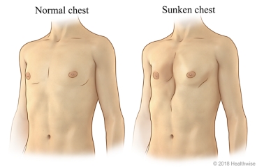 A normal chest compared to a sunken chest (pectus excavatum)