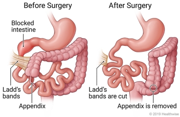 Blocked intestine, Ladd's bands, and appendix before surgery, compared with intestine after Ladd's bands are cut and appendix is removed.