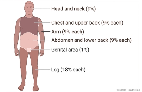 Body divided into areas showing percentages of surface area.