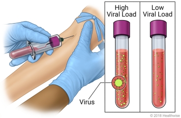Drawing blood sample from arm, with comparison of samples with high viral load and low viral load