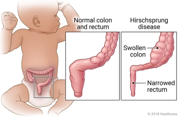 Location of the colon in an infant, with detail of a normal colon and a colon with Hirschsprung disease.