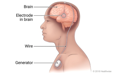 Side view of electrode in brain, with wire connecting to generator located in chest