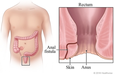Location of large intestine, with detail of rectum and anus showing anal fistula