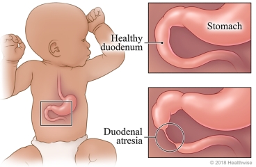 Location of the duodenum, with detail of a healthy duodenum and duodenal atresia