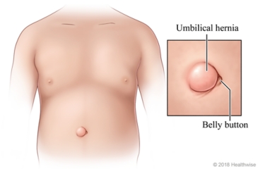 An umbilical hernia next to the belly button