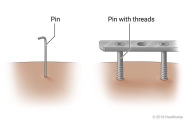 Examples of pins, with and without threads, sticking out of the skin