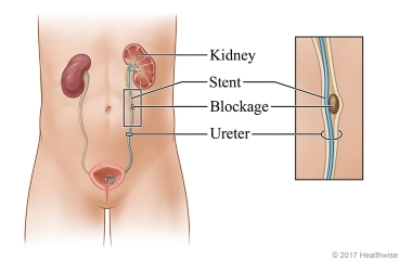 Ureter, showing blockage and stent from kidney to bladder