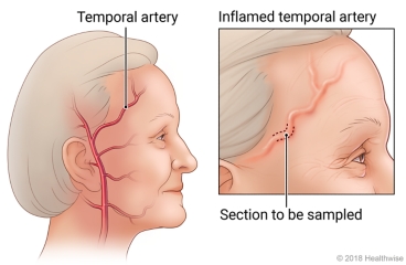 Temporal artery with detail of section of artery to be sampled