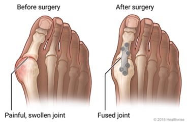 Before and after metatarsal phalangeal joint fusion, showing a painful and swollen toe joint before surgery and showing a plate and screws on the fused joint of the big toe after surgery