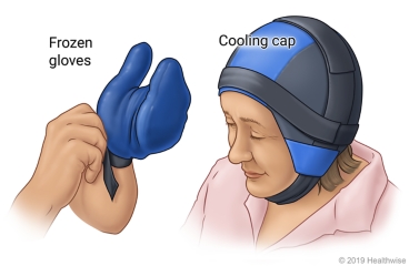 Examples of a frozen glove and a cooling cap