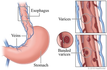 Esophagus and stomach, with detail of varices in the veins with and without bands