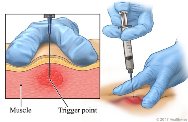 Injection of medicine into trigger point of muscle