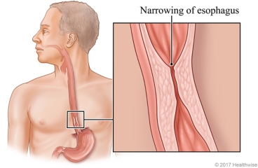 Esophagus with detail of narrow section