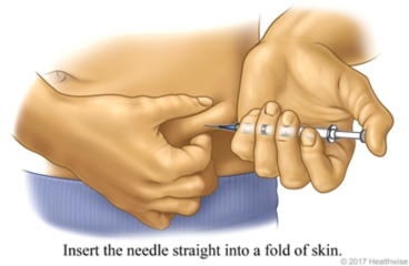 Person giving self a shot, inserting needle straight into fold of skin on side of belly.
