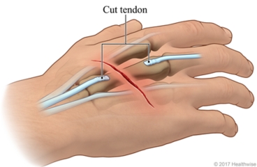 Top view of hand showing normal tendons and cut tendon