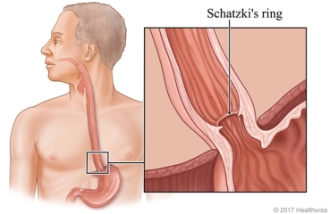 Location of esophagus, with detail of Schatzki's ring.