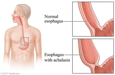 Esophagus, with detail of normal esophagus and one with a wide lower section from achalasia