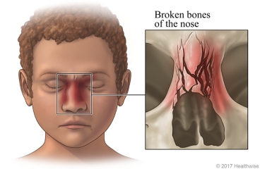 Child with broken nose, with inside view of broken nose bones.