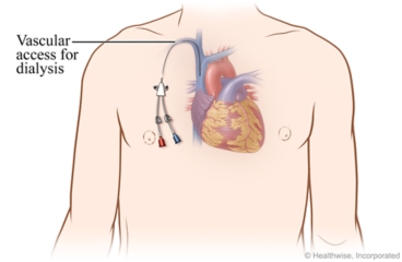 Chest with catheter for hemodialysis and vascular access