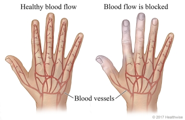 Blood vessels of the hand, showing healthy blood flow and blocked blood flow