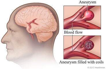 Before and after treatment of an aneurysm with coil