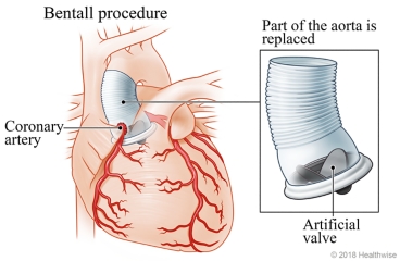 Bentall procedure, showing the heart, the coronary artery, and detail of the section of the aorta that has been replaced.