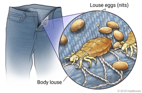 Body lice in seam of pants, with close-up of body lice and eggs (nits)