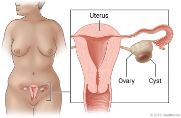 Hemorrhagic Ovarian Cyst: Care Instructions